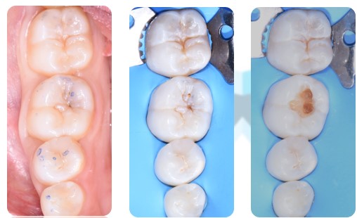 Come riconoscere un dente cariato