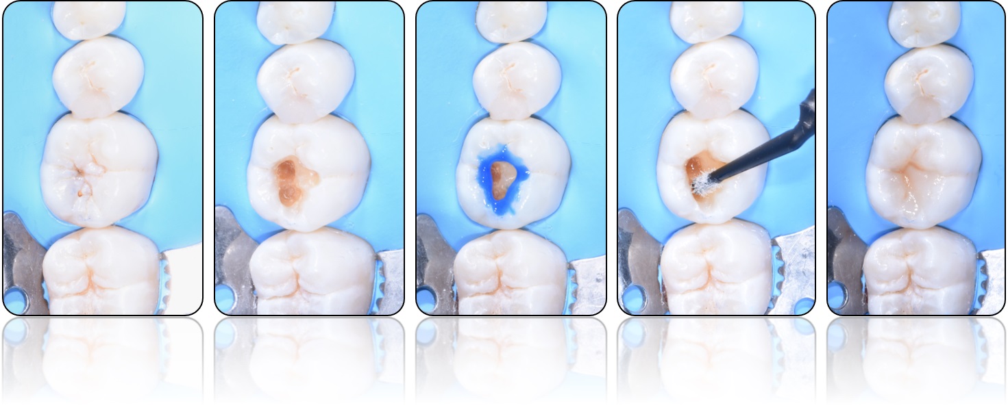 Cura di un dente cariato