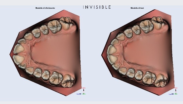 Spostamento dei denti con allineatori